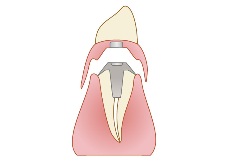 マイクロスコープを使用した虫歯治療