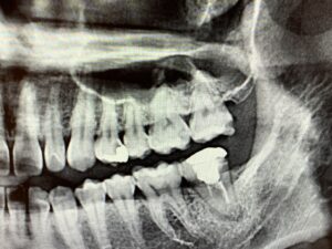 恵比寿駅　徒歩3分の歯医者　恵比寿南DENTAL 虫歯治療