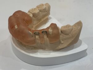 恵比寿駅　徒歩3分の歯医者　恵比寿南DENTAL インプラント治療