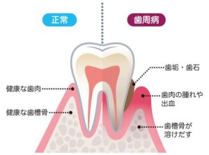 恵比寿駅　徒歩3分の歯医者　恵比寿南DENTAL 歯周病